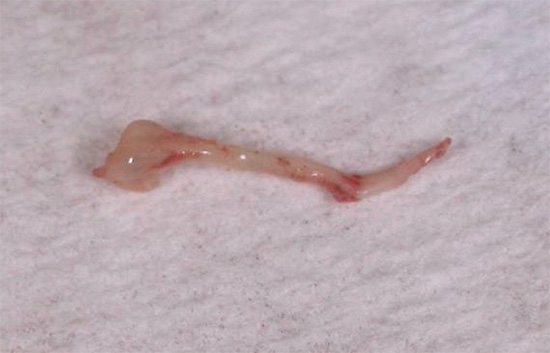 Fotografie ukazuje nerv odebraný ze zubu.