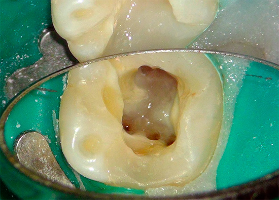 Many dentists believe that after cleaning the canals and installing the fillings, normal pain in the tooth can persist for several days, up to one week.
