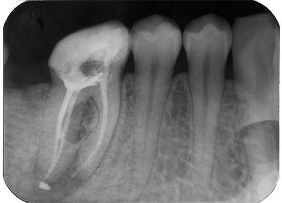 Le matériel sorti au-delà de l'apex de la racine peut entraîner de très longues douleurs dans la dent, jusqu'à plusieurs mois.