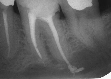 Cu inflamația țesuturilor din jurul materialului de umplere, poate fi dureros să mușcați pe un dinte și o persoană nu poate mânca normal.