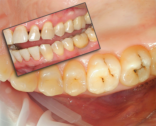Dişler çeşitli nedenlerden dolayı acı çekebilir ve daha sonra acıyı hafifletmek için belirli bir durumda ne yapacağını anlamaya çalışacağız.