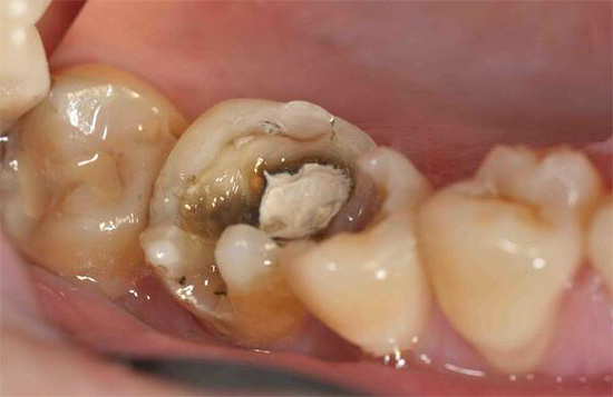 Instalace devitalizační pasty na bázi sloučenin arsenu na zubu přináší značná rizika ...
