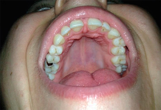 Selon l'une des recettes populaires pour soulager les maux de dents, un morceau de propolis doit être placé dans une cavité carieuse profonde.