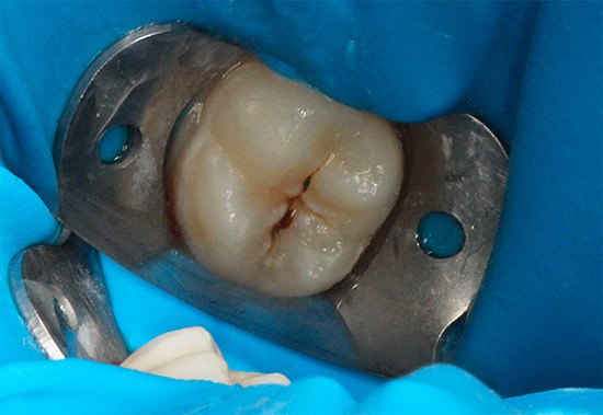 Als de pulp niet wordt aangetast, wordt de carieuze tand meestal in één keer behandeld.