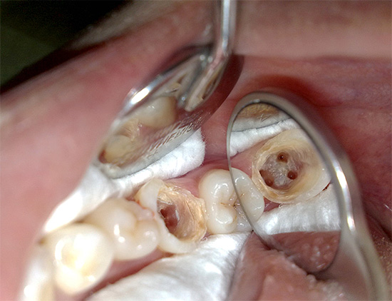 Canalele radiculare ale dintelui sunt clar vizibile în fotografie, fiecare dintre ele trebuind curățat și sigilat complet în timpul tratamentului.