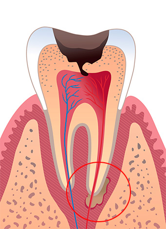 Con inflamación en la raíz del diente, se desarrolla periodontitis ...