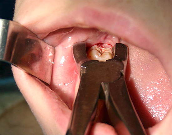 Zor diş çıkarma bilgelik dişleri ile, genellikle ağrı ve olası komplikasyonlardan kurtulmanın en iyi yolu onu çıkarmaktır.