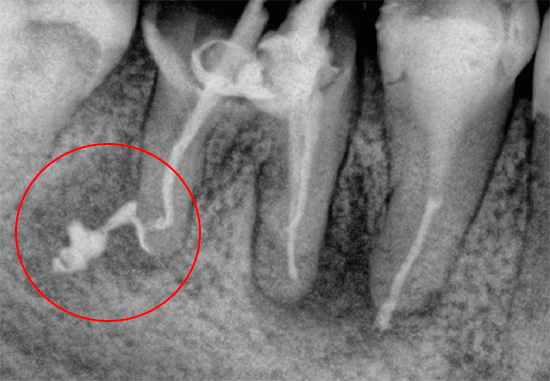 Този рентген показва материал за пълнене, който е отстранен извън корена.