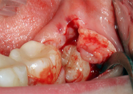 Sur cette photo, une dent de sagesse est visible dans la section des gencives.