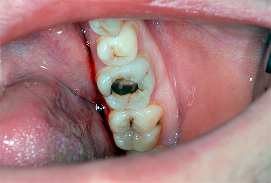Ibland kan en dålig tand till och med provokera bihåleinflammation ...