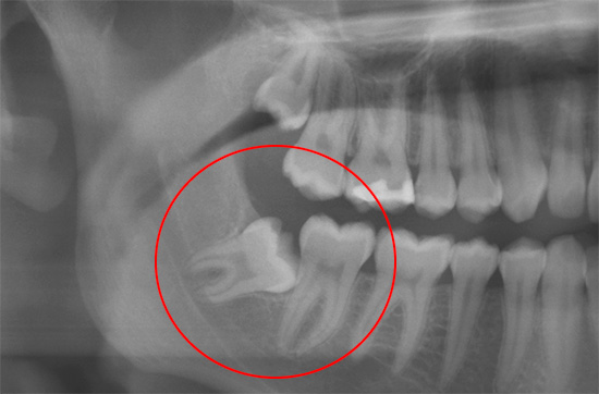 An improperly growing wisdom tooth can provoke severe and protracted headaches.