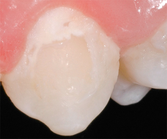 Na fotografii je znázornený príklad zubného kazu v mieste spotu.