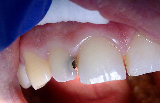 При дълбок кариес зъбът може да стане много чувствителен към различни дразнители.
