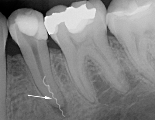 Obrázek jasně ukazuje kus zubního nástroje zlomeného v kořenovém kanálu.