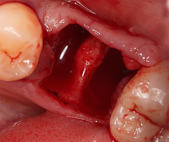 Zistíme, ako dlho sa guma zvyčajne zotavuje po extrakcii zubov a ako urýchliť proces hojenia ...
