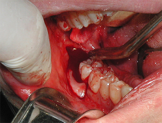 Amb l'extracció complexa de dents de saviesa, sovint es produeix un trauma greu als teixits tous que l'envolten ...