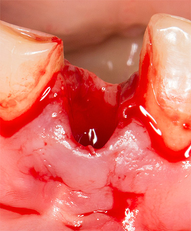 Przy słabej krzepliwości krwi możliwe jest bardzo długotrwałe krwawienie z otworu zęba.