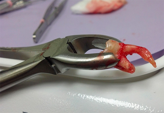 Existuje niekoľko spôsobov, ako urýchliť proces hojenia ďasien po extrakcii zubov ...