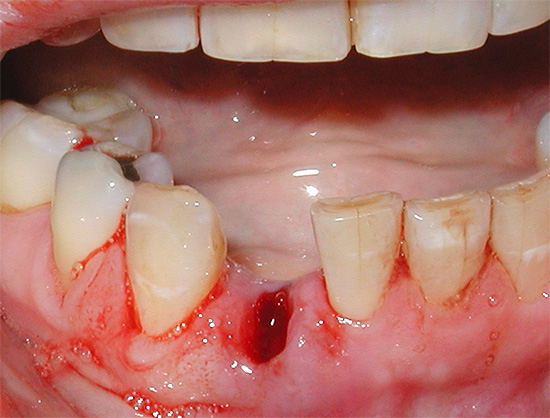 Una dintre problemele cu care se confruntă pacienții imediat după extragerea dinților este sângerarea prelungită a găurii.
