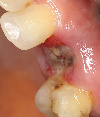 Si les résidus de dents carieuses ne sont pas complètement éliminés du trou, la plaie peut s'infecter et guérir très lentement.