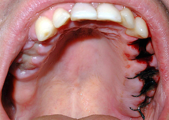 Die richtige Pflege des verletzten Zahnfleisches verringert das Risiko schwerer Entzündungen erheblich, was dazu führt, dass Wunden schneller heilen.