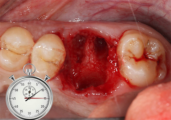 Konvergencia okrajov ďasien nad dierou sa spravidla objaví do 2,5 týždňa po extrakcii zuba.