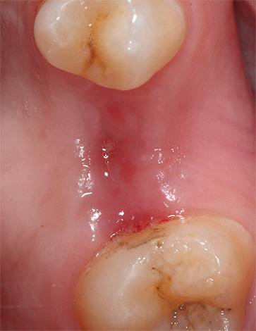 De foto toont een bijna volledig genezen tandvlees.