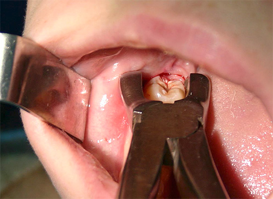 Tanduttag är en slags kirurgisk operation, och efter det kan i vissa fall komplikationer uppstå ...