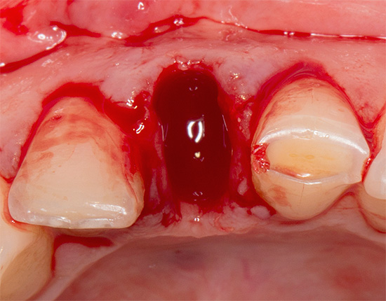 Przedłużone krwawienie z wgłębieniem zawsze ma swoje przyczyny, które należało zidentyfikować nawet przed usunięciem zęba.