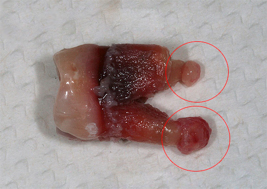 На фотографији је приказан зуб са цистама на коренима - ако део таквог корена остане у рупи, онда пацијент може развити озбиљну компликацију ...