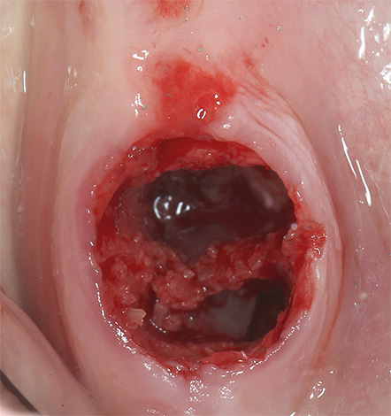 С нагъването на зъбната дупка се развива алвеолит