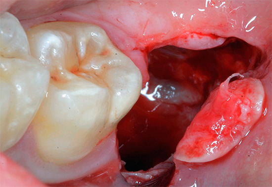 Ir vairāki tipiski simptomi un pazīmes, pēc kurām var atpazīt komplikāciju pēc zobu ekstrakcijas, un to nevar ignorēt.