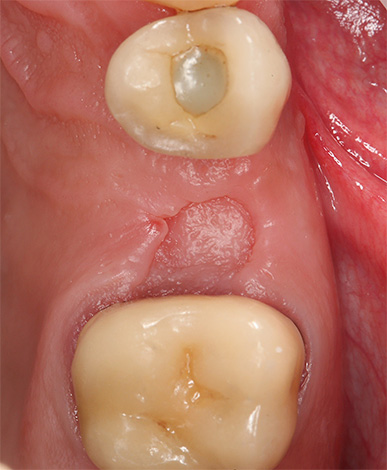 Foto av ett läkt tandhål