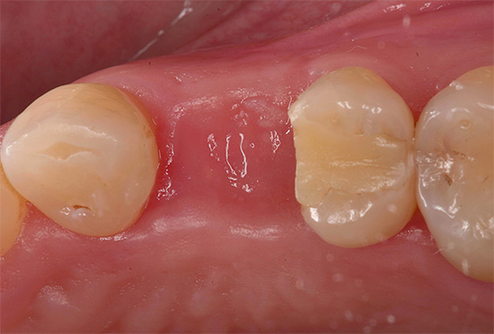 Chiar dacă gingia rănită s-a vindecat complet, acest lucru nu înseamnă că în viitor nu veți simți consecințele pe termen lung ale extracției dinților.