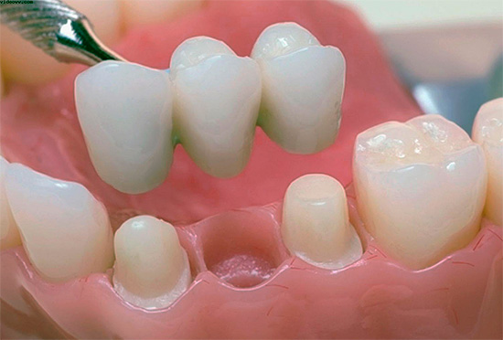 Such a bridge makes it possible to restore the functions of a lost tooth and prevent malocclusion in the future.
