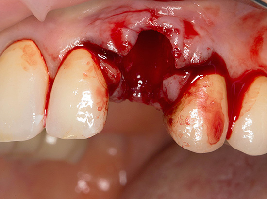Zdjęcie pokazuje świeżą dziurę w zębie