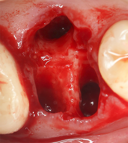 Krvácanie z diery po extrakcii zuba je niekedy veľmi dlhé až niekoľko dní v rade.