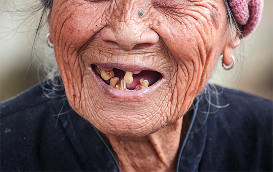 Huomaa, että vanhoilla naisilla, jotka puhuvat hammassärkyä (ja muita vaivoja), suuontelon tilanne on kaukana parhaasta tavasta ...