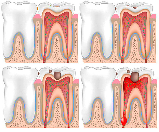 The entry of bacteria through the carious cavity into the pulp chamber of the tooth inevitably leads to inflammation of the pulp - and this is the most common mechanism for the development of acute pulpitis.