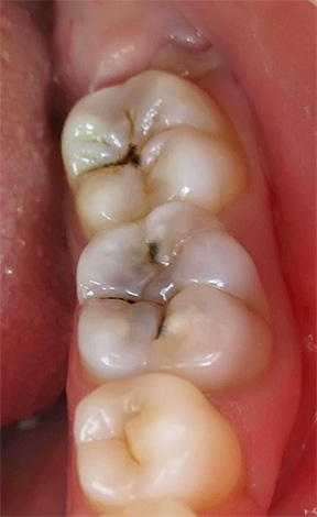 A causa del fatto che il dolore nella pulpite purulenta acuta spesso non ha una certa localizzazione, può essere abbastanza difficile per un medico trovare un dente cattivo senza attrezzature adeguate.