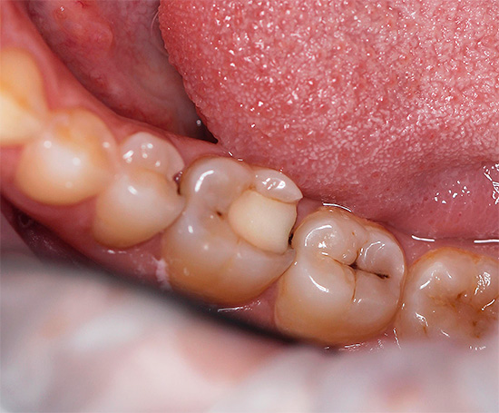 Dit kan op tanden lijken, waarvan er één wordt aangetast door acute pulpitis, maar welke? ..