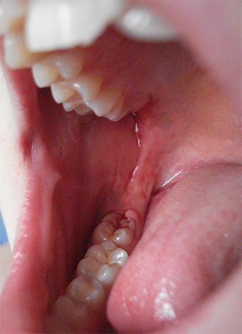 Dažnai skausmo priežastis yra išminties dantis, tačiau žmogui gali atrodyti, kad problema yra kažkur ant viršutinio žandikaulio.