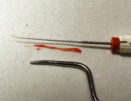 La photographie montre la pulpe extraite du canal radiculaire de la dent
