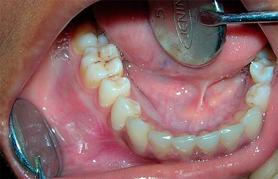 Hammassärkyjen syiden poistamiseksi luotettavasti hammaslääkäri ei monissa tapauksissa voi tehdä ilman interventiota.