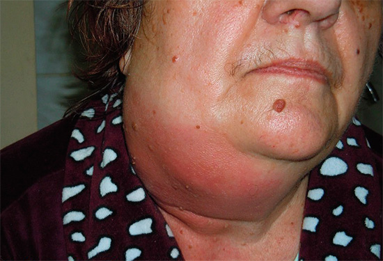 The photo shows odontogenic phlegmon - a life-threatening inflammation.