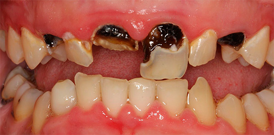 Si vous ne comptez que sur des complots et ne vous rendez pas longtemps chez le dentiste, l'état des dents peut devenir très déplorable.