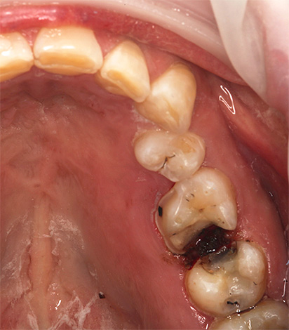 S ovim stanjem zuba, bolje je tražiti ne jaku zavjeru od boli, već dobrog stomatologa.