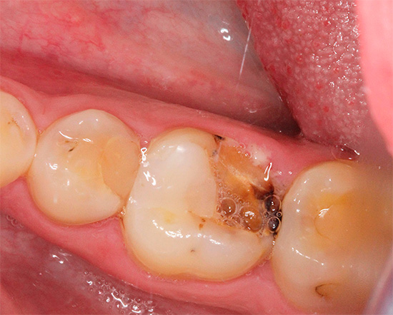 A volte un mal di denti può essere rimosso inserendo un batuffolo di cotone imbevuto di una soluzione di novocaina nella cavità.