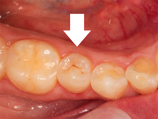 Selv om det ikke er smerter ennå, men tannen påvirkes av karies, er det best å leges så raskt som mulig.