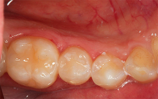 Une photographie d'une dent après traitement et obturation.